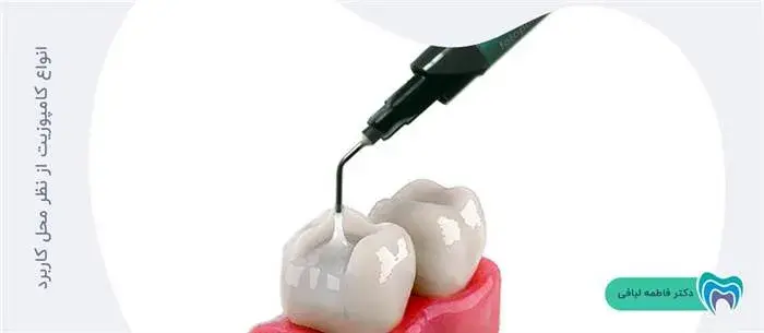 کامپوزیت دندان بر اساس کاربرد چه دسته بندی هایی دارد؟