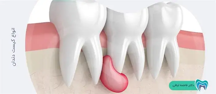 کیست دندان دارای چند نوع است؟
