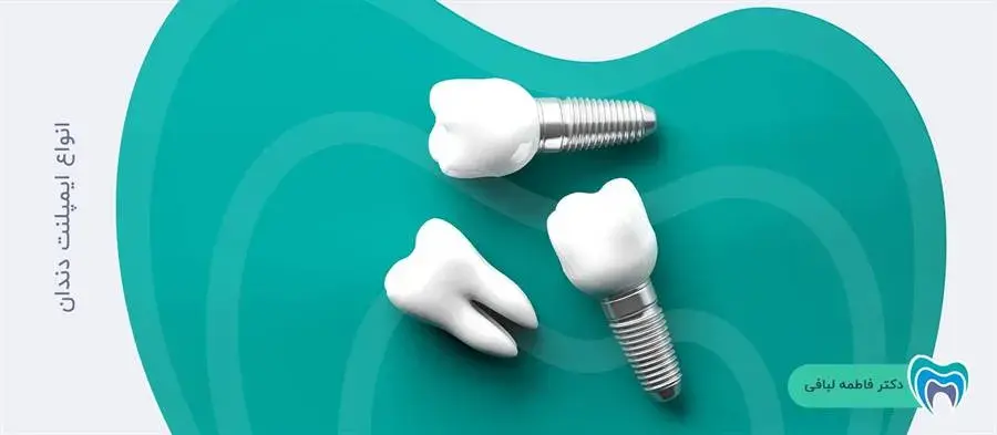 ایمپلنت دندان شامل چه انواعی میشود؟