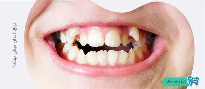 انواع دندان نیش نهفته کدام‌اند؟