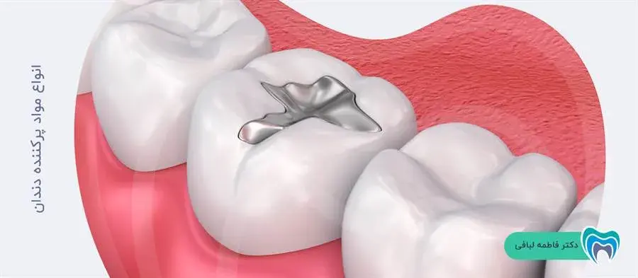 مواد پرکننده دندان چند نوع دارد؟