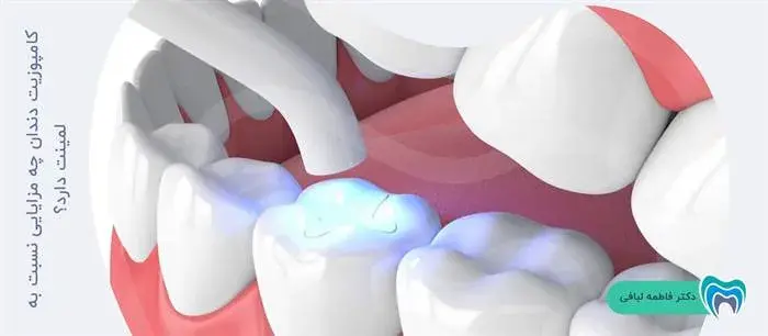 مزایای کامپوزیت دندان نسبت به لمینت 