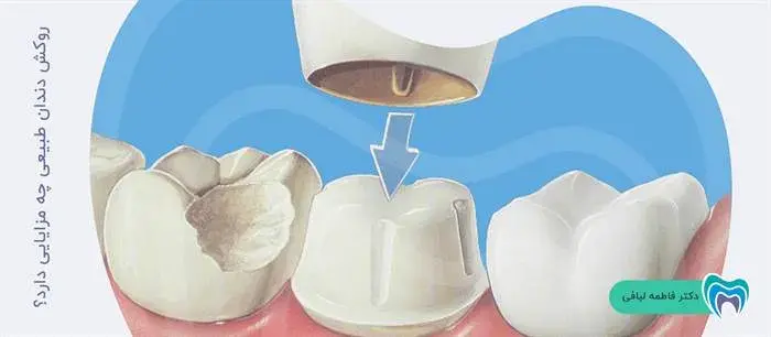 مزایای روکش دندان