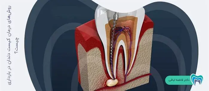 انواع روش‌هایی که به درمان کیست دندان در حاملگی کمک میکند 