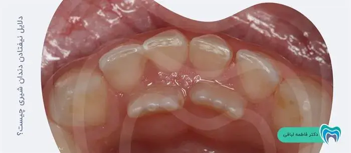 دلایل نیفتادن دندان شیری چیست؟