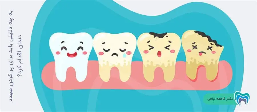 به چه علتی برای پر کردن مجدد دندان باید به دندانپزشک مراجعه کرد؟