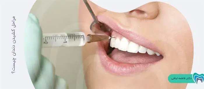 کشیدن دندان شامل چه مراحلی است؟