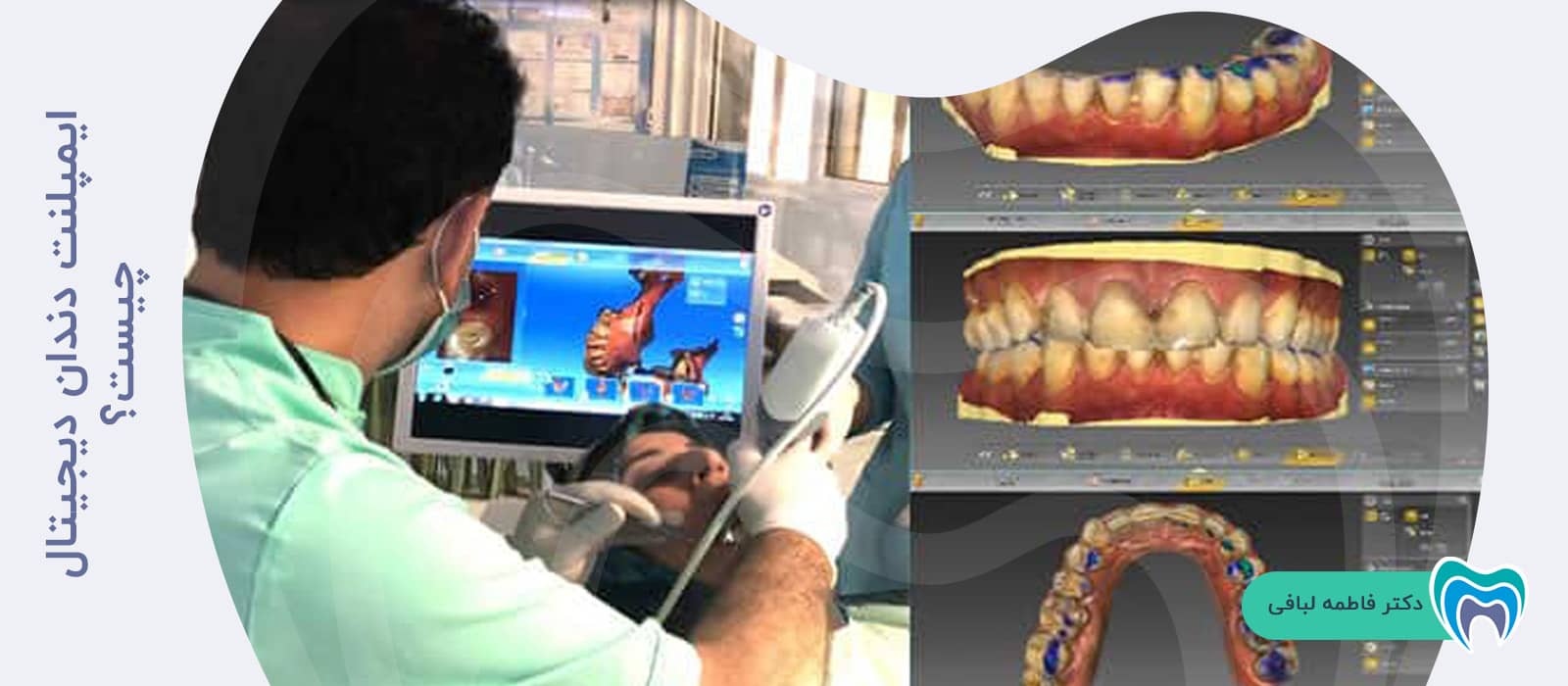 ایمپلنت دندان دیجیتال چیست؟