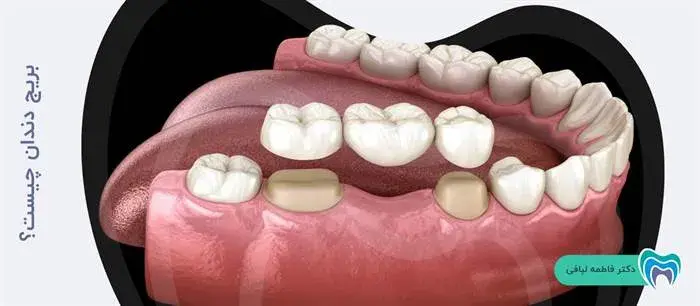 بریج دندان چیست؟