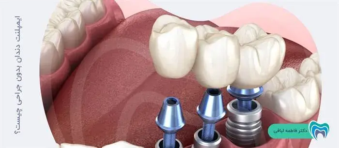 ایمپلنت دندان بدون جراحی 