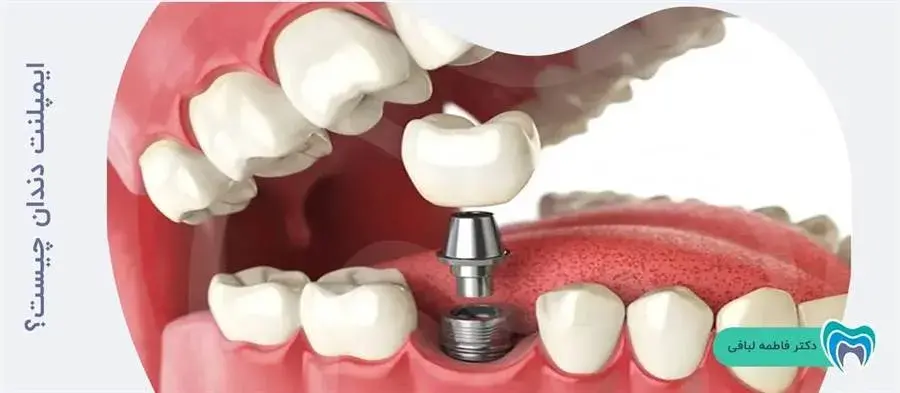کاشت دندان به روش ایمپلنت چیست؟