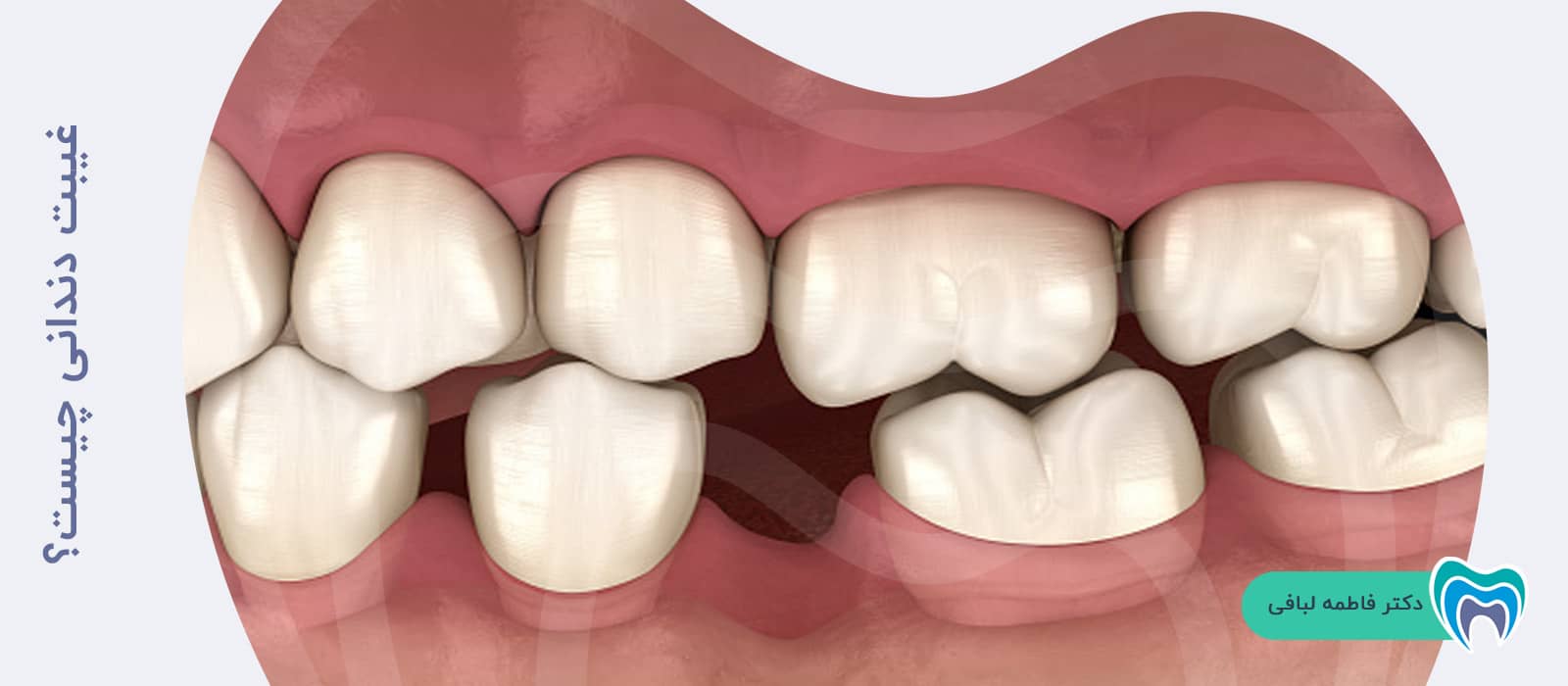 غیبت دندانی چیست؟