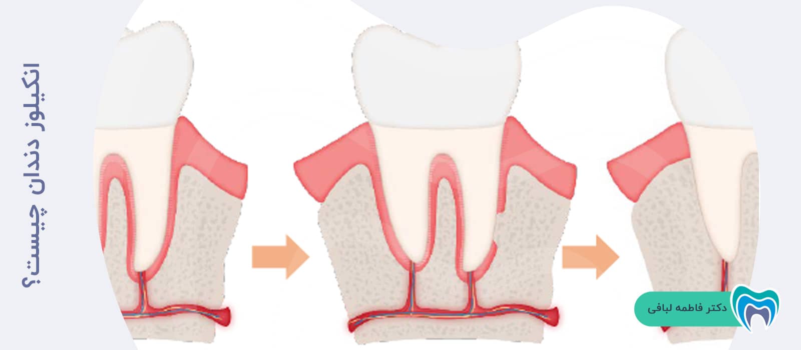 انکیلوز دندان چیست؟
