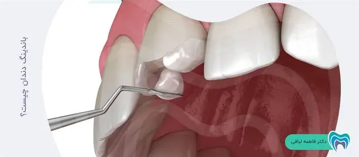 باندینگ دندان چیست؟