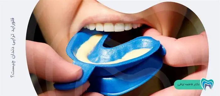 فلوراید تراپی دندان چیست؟