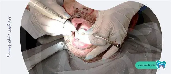 جرمگیری دندان چیست؟