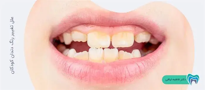  تغییر رنگ دندان در کودکان