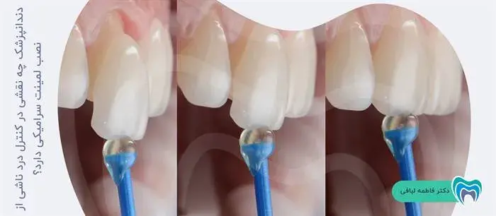 نقش دندانپزشک در کنترل درد ناشی از نصب لمینت 