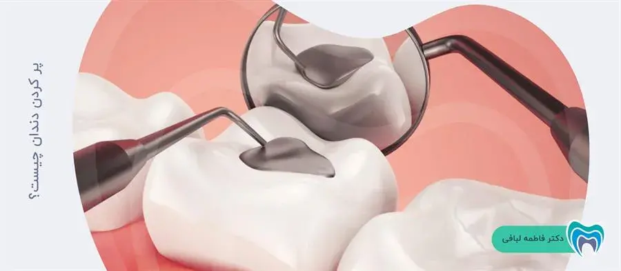 آشنایی با درمان پر کردن دندان