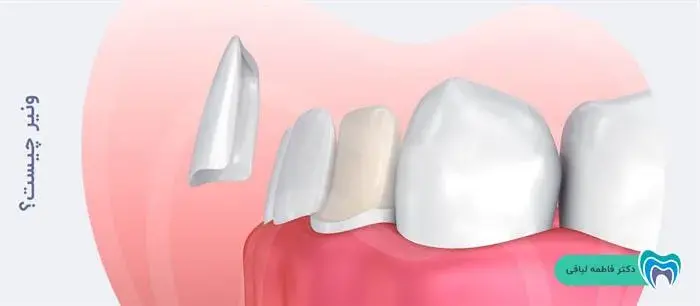 ونیر دندان چیست؟