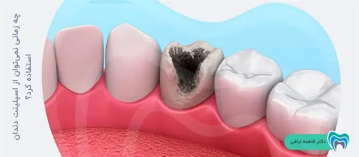 اسپلینت دندان برای چه کسانی مناسب نیست؟