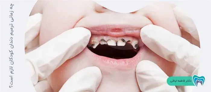 چه زمانی ترمیم دندان کودکان لازم است؟