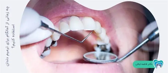 چه زمانی از آمالگام برای ترمیم دندان استفاده کنیم؟