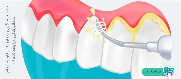 کدام دندانپزشکان از ایرفلو برای جرم گیری استفاده می‌کنند؟