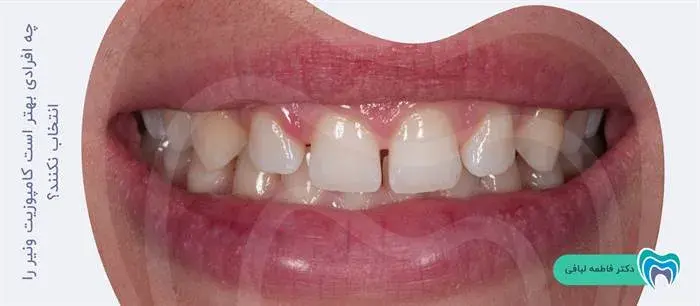 کامپوزیت دندان به چه افرادی پیشنهاد نمی شود؟