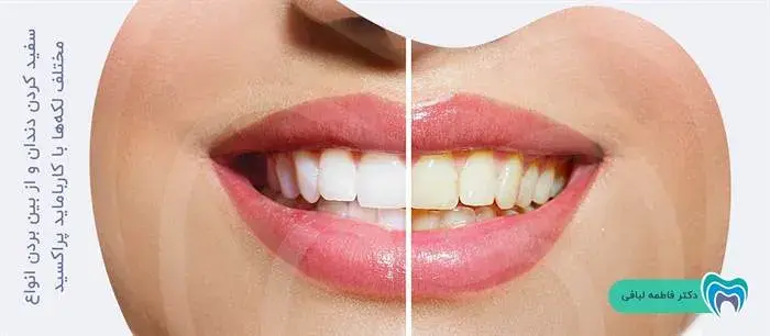 سفید کردن دندان و از بین بردن انواع مختلف لکه‌ها با کارباماید پراکسید