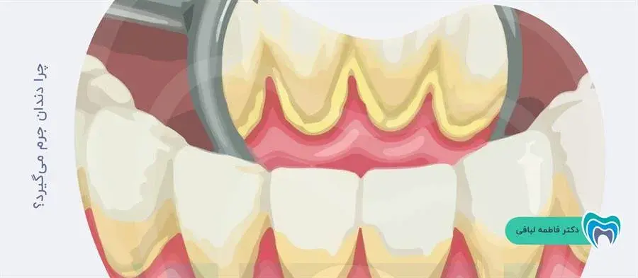 علت جرم گرفتن دندان چیست؟