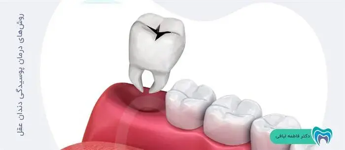 پوسیدگی دندان عقل را با چه روشهایی میتوان درمان نمود؟