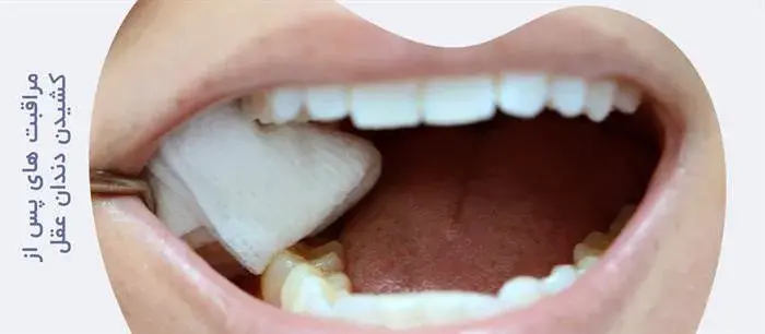 مراقبت های پس از کشیدن دندان عقل