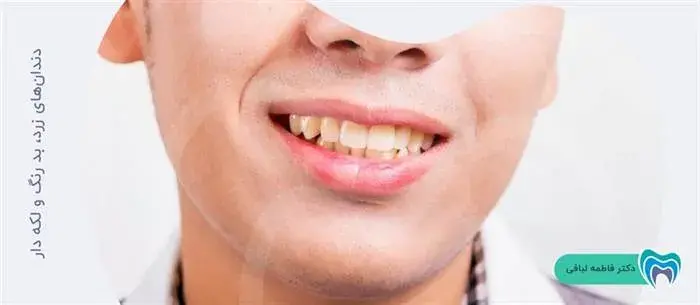 سفید کردن دندانهای زرد با کامپوزیت