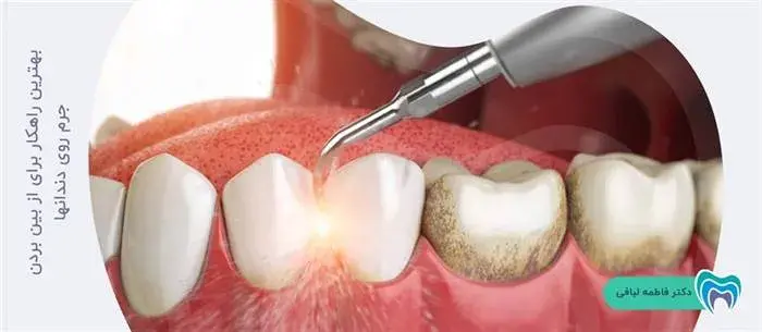 جرم گیری دندان در مطب دندانپزشکی، بهترین راه برای رفع جرم های دندانی