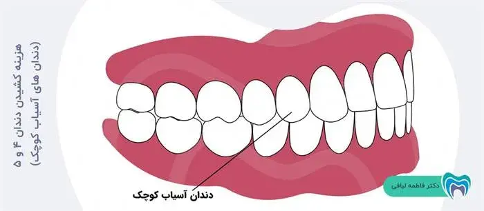 هزینه کشیدن دندان 4 و 5 (دندان های آسیاب کوچک)