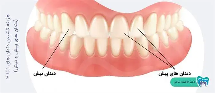 هزینه کشیدن دندان های 1 تا 3 (دندان های پیش و نیش)