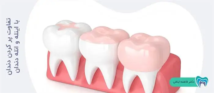 تفاوت پر کردن دندان با اینله و انله دندان