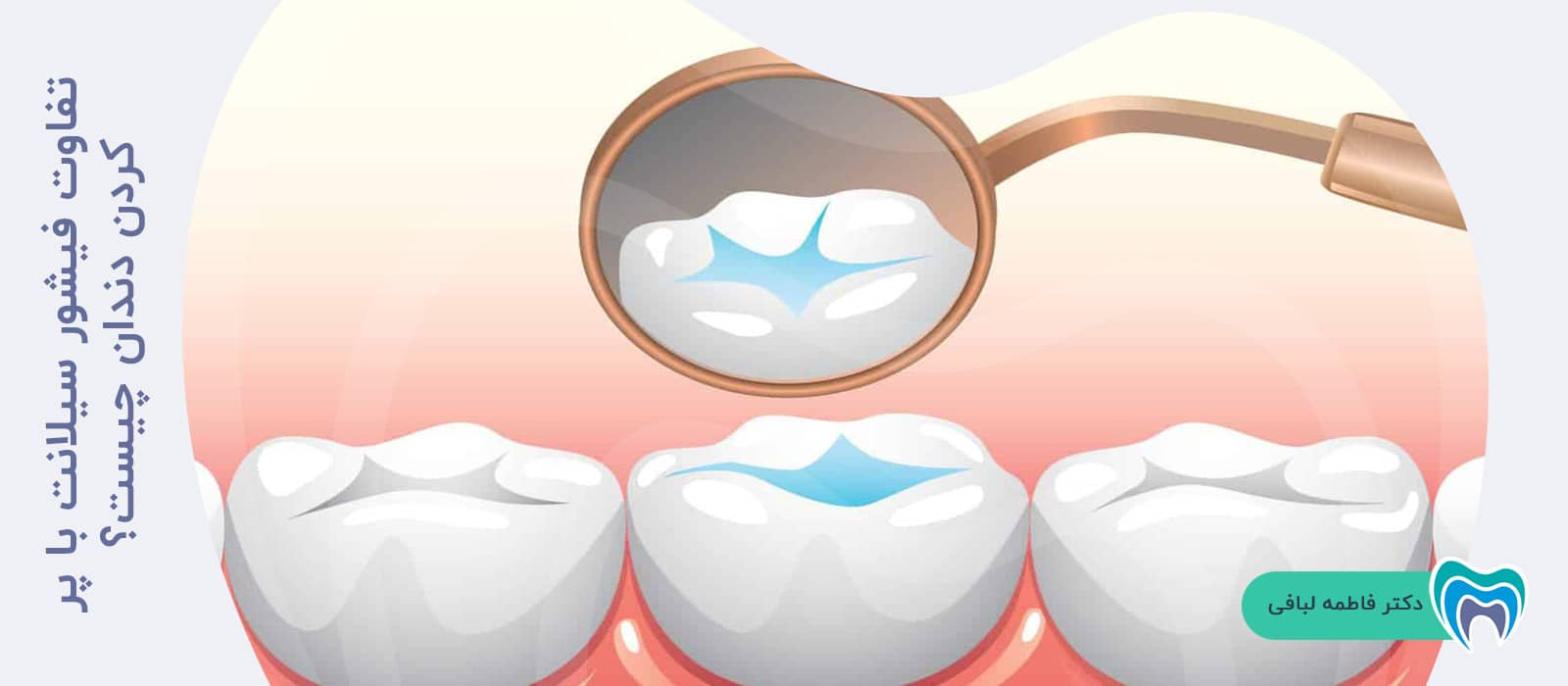 تفاوت فیشور سیلانت با پر کردن دندان چیست؟