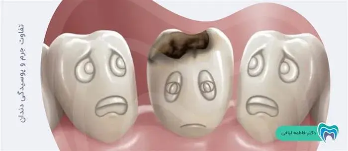جرم و پوسیدگی دندان چه تفاوتی دارند؟