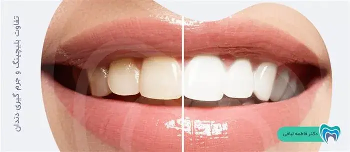 آشنایی با 3 تفاوت مهم جرم گیری و بلیچینگ دندان