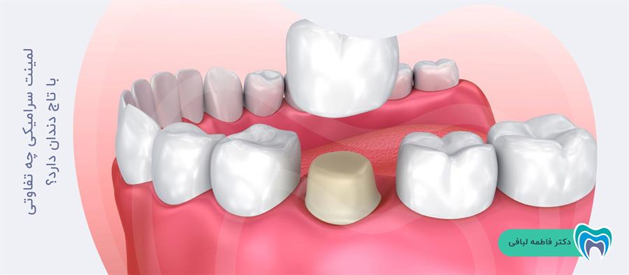 تفاوت تاج دندان با لمینت دندان را بشناسید