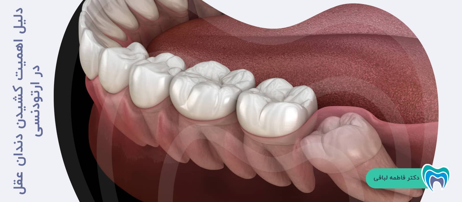 دلیل اهمیت کشیدن دندان عقل در ارتودنسی