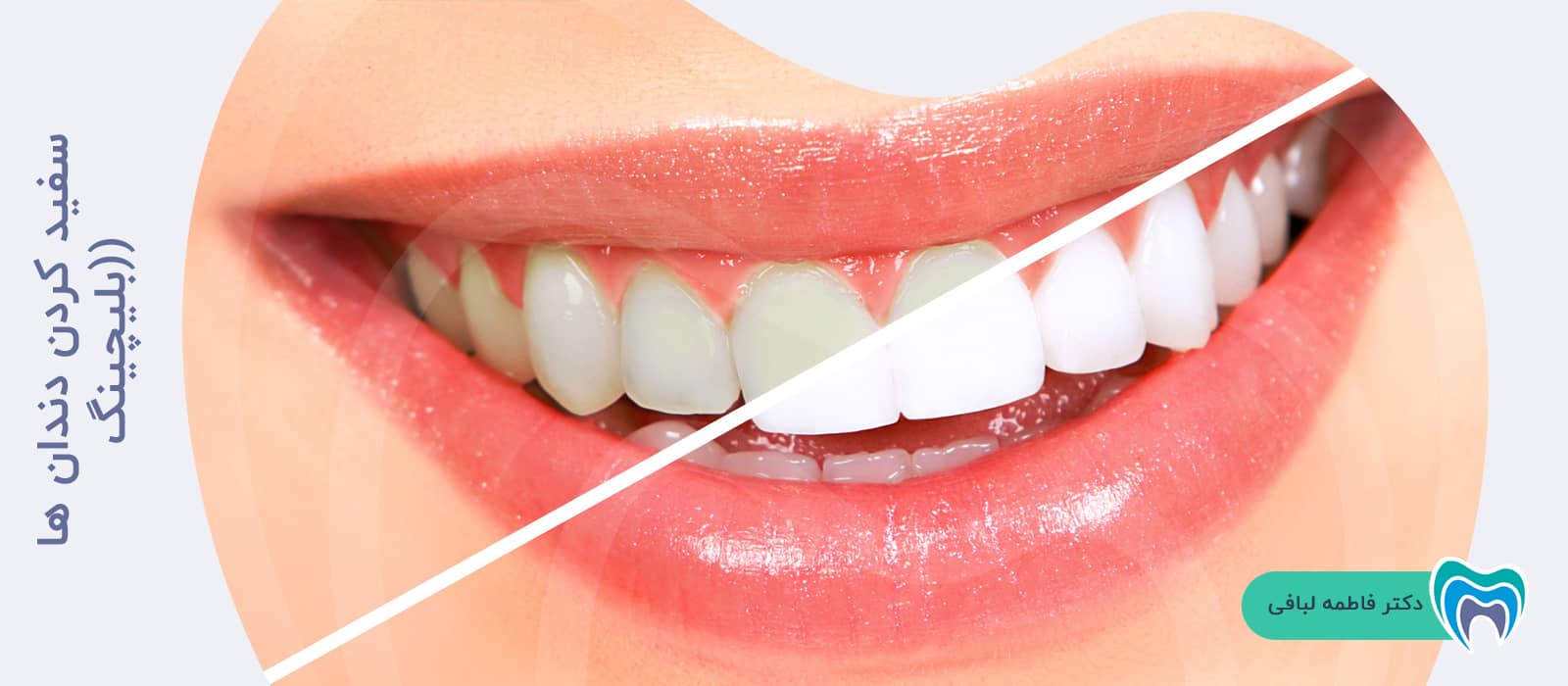 سفید کردن دندان ها (بلیچینگ)